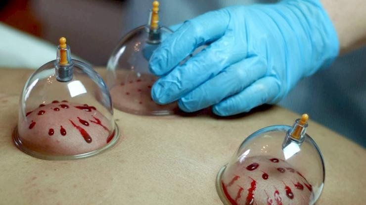 Hijama Center Abbottabad | Hijama/Cupping Services